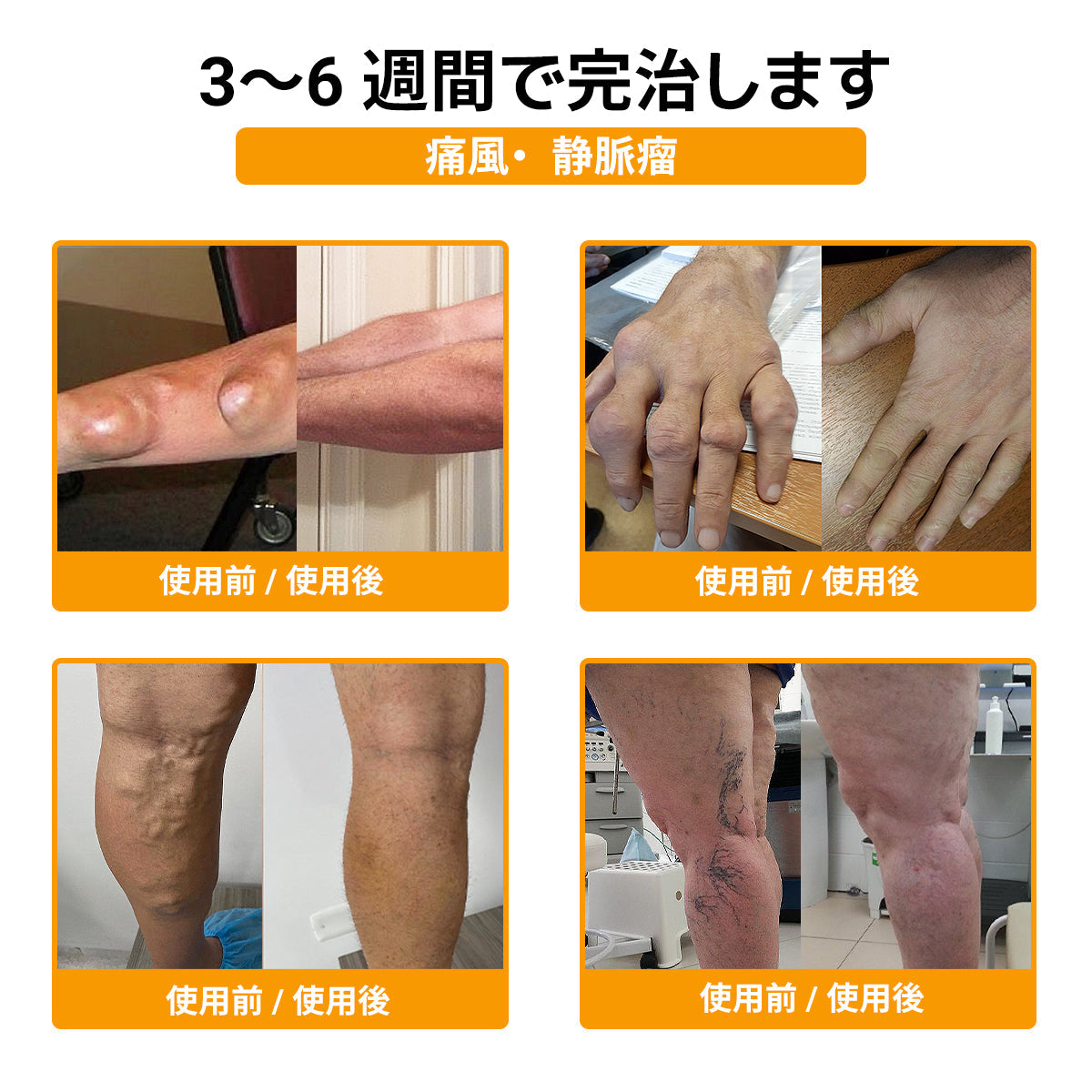 🛒BOMSTF® ハチ毒配合 痛み緩和・骨の治癒クリーム 🎊🎊（特に高齢者向け-🔥